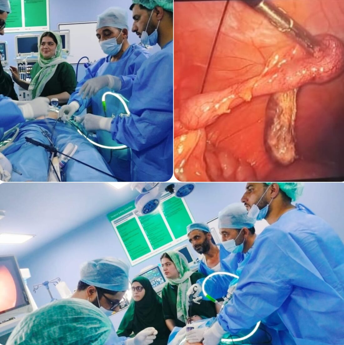 DH Bandipora Performs First Laparoscopic Appendectomy, Enhances Local Surgical Care.